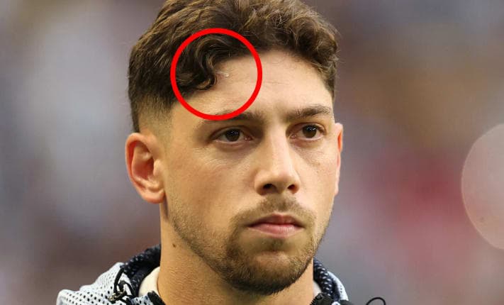 Federico Valverde scar spotted in Uruguay vs Saudi Arabia World Cup clash